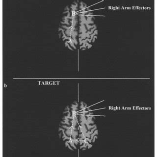 Image result for Contralateral Hemisphere