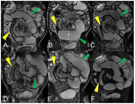 Small Bowel Imaging from Stepchild of Roentgenology to MR Enterography ...