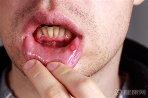 口腔癌早期有什么征兆？记住5个症状-健康世界-万维读者网（电脑版）
