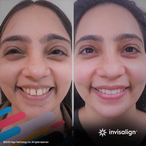 Why Invisalign?