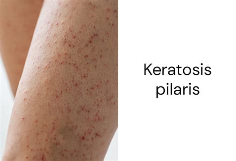 11% AHA + 2% Salicylic Acid Body Wash for women & men – thedeconstruct