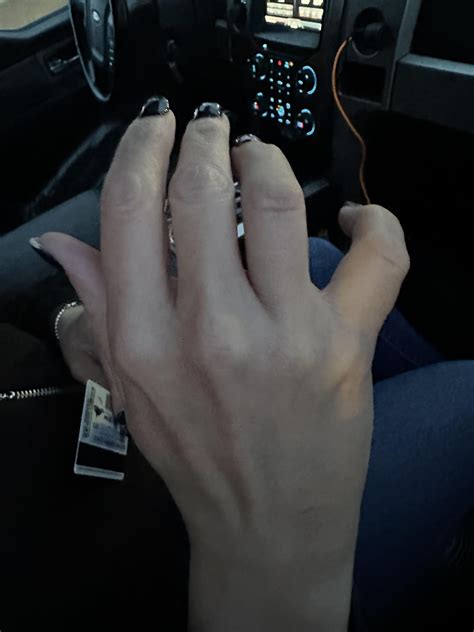 Broken finger in a car accident this morning : r/MedicalGore