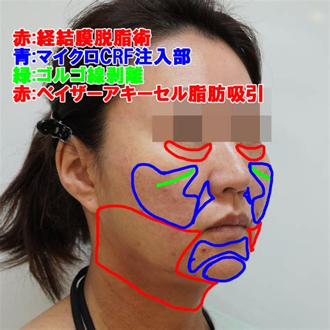 【又吉院長 ベイザー脂肪吸引アキーセル＋マイクロCRF＋ゴルゴ線剥離】40代女性 | 銀座シンシアスタッフ☆みんなのキレイのお手伝い☆