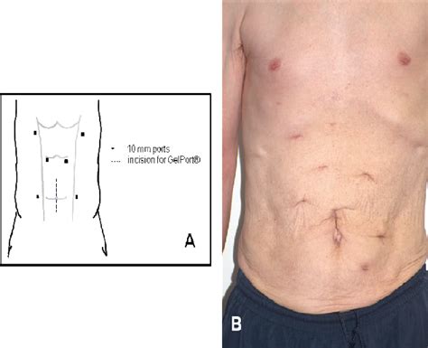 Image result for Hand-Assisted Nephrectomy