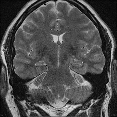 Radiopaedia case Mesial temporal sclerosis id: 26379 study: 26514 - NC Commons