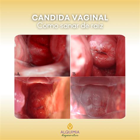 CANDIDA VAGINAL - Alquimia Regenerativa