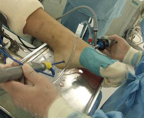 Plantar Fasciitis Surgery