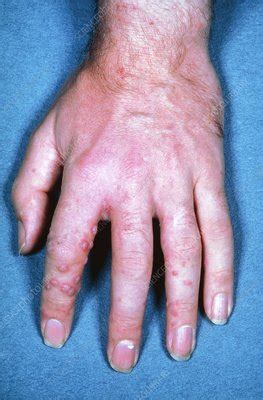 Shingles rash on hand - Stock Image - M260/0012 - Science Photo Library
