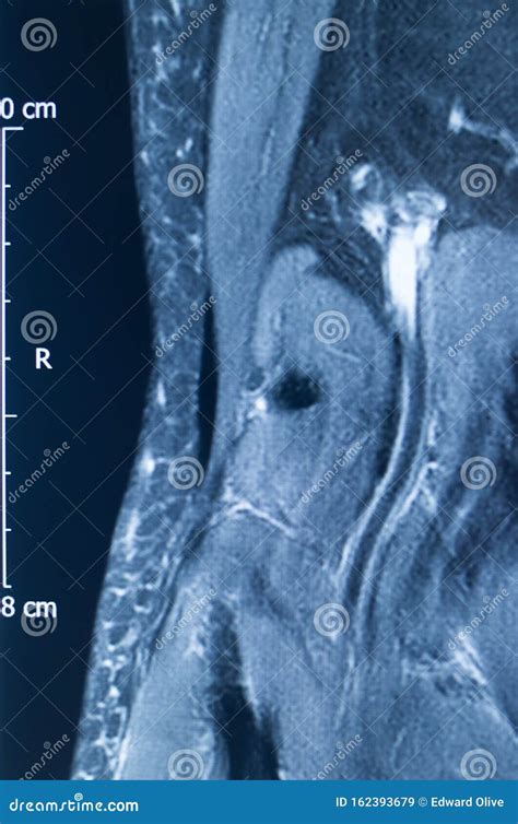 Knee injury mri mcl tear stock image. Image of magnetic - 162393679