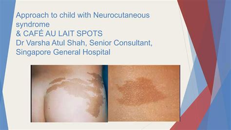 Approach to Cafe au lait spots in children | PPTX