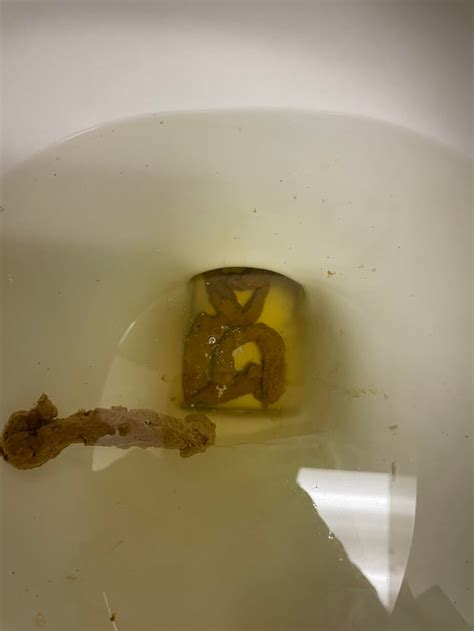 Image result for Colon Cancer Poop