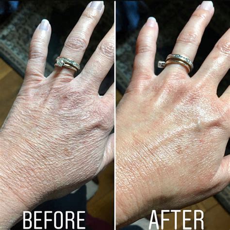 How to Heal Chapped Hands at Home | 707 Flora