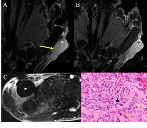 Image result for Soft Tissue Sarcoma Hand