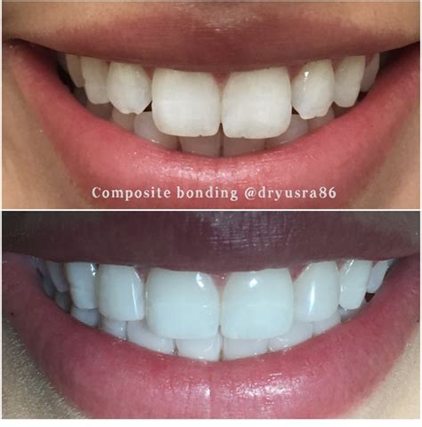 Composite Bonding Liverpool | Cosmetic Dentistry | Dr Yusra