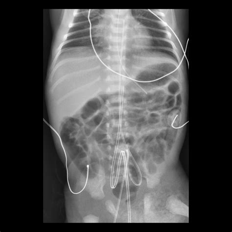 Umbilical Arterial Catheter Malfunction / Malposition / Misposition / Misplacement | Pediatric ...