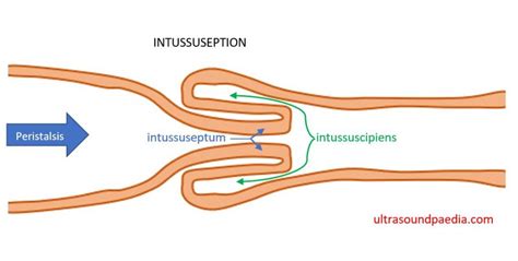 Image result for Intussusception Symptoms