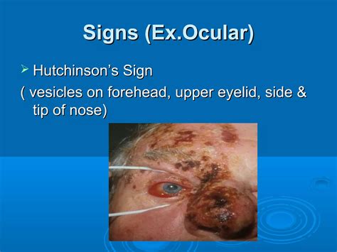 Herpes zoster ophthalmicus | PPT