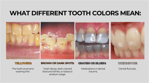 Image result for Discolored Tooth
