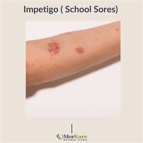 Impetigo School Sores - Morkare Natural Clinic