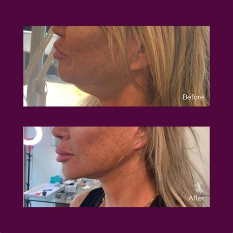 Non-surgical Face Lift - Conquer 180