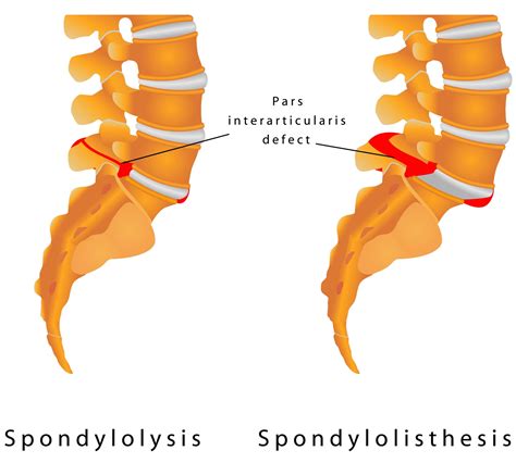 A Spotlight on Spondylolisthesis From Houston Spine & Rehab