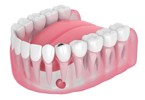 Popping Abscess Tooth 的图像结果