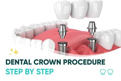 Image result for Crown Procedure