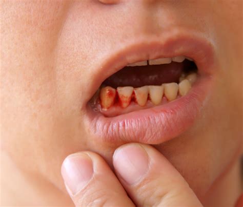 Tips｜牙龈突然出血要小心，除了牙周病还可能是肝生病！ | Xuan