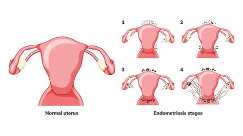 How to Prevent Endometriosis: The Overlooked Factors That Matter Most ...