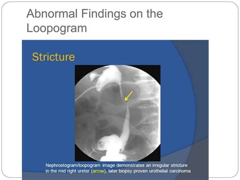 Image result for Distal Loopogram