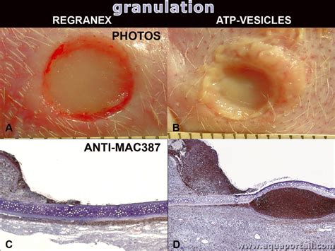 Granulation Tissue Wound