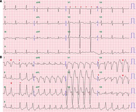 A Peculiar Wide Complex Tachycardia During Flecainide Treatment ...