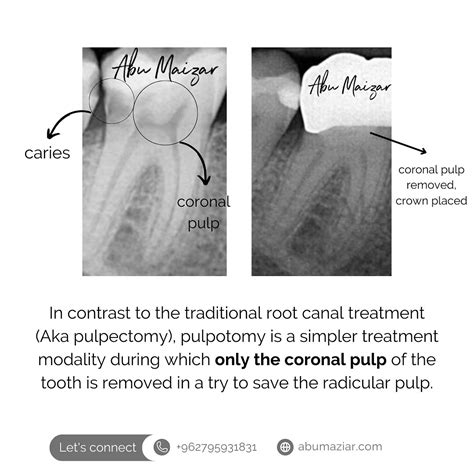 Pulpotomy Pulpotomy Vs Pulpectomy 🦷 Read Our New Blog Post To Learn