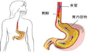 咽喉反流 vs. 胃食道反流 - 每日頭條