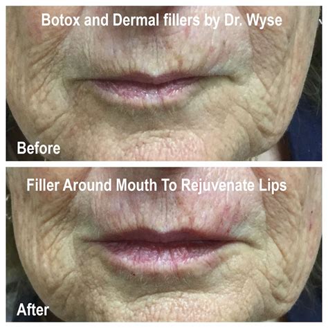 Top 97+ Pictures Before And After Pictures Of Botox Around The Mouth Stunning