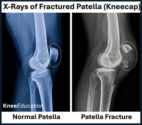 Patellar Fracture - Knee Education