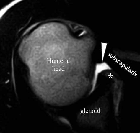 Anterior subluxation of the glenohumeral joint during hyperextension ...