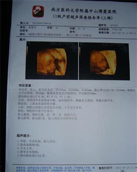 【怀孕b超报告单模板】怀孕三个半月肚子图？b超报告单模板_第二人生