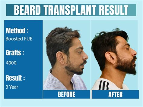 How much does a beard transplant cost India?