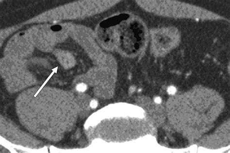 Meckels Diverticulum
