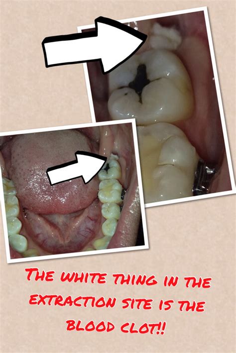 What Does It Look Like When A Blood Clot Comes Out After Tooth Extraction at Sophia Joyce blog