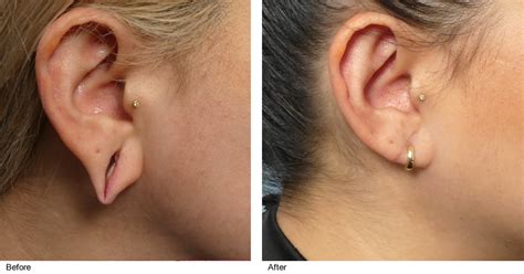 Image result for Ear Modification