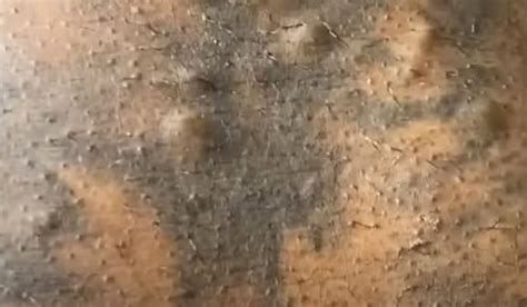 Image result for Back Full of Exploding Cysts