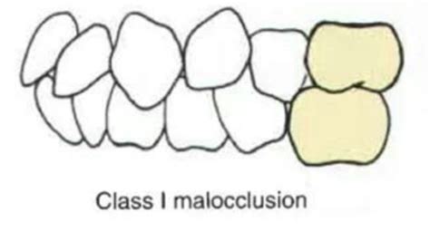 Image result for Two Walled Defect Perio