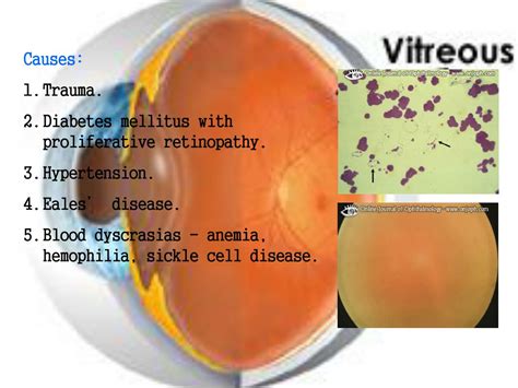 PPT - Vitreous Anatomy & Diseases: Understanding Symptoms, Causes, and Treatment Options ...