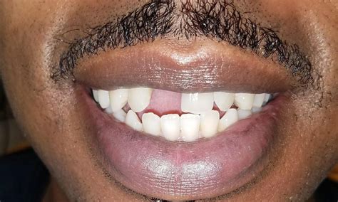 Image result for First Tooth Overall