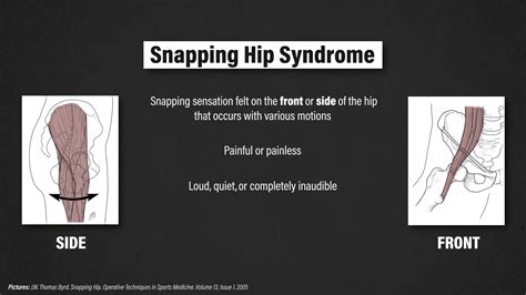 Snapping Hip Syndrome - E3 Rehab