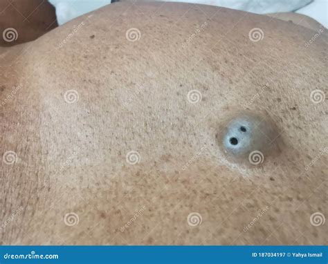 SEBACEOUS Cyst with Punctum on the Abdominal Wall Skin Stock Image - Image of meal, food: 187034197