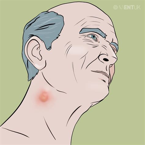 Swollen Glands In Neck On One Side