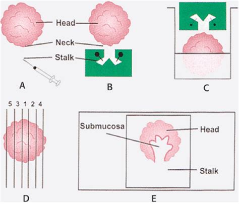 Serrated Polyps | Abdominal Key